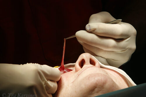 7433 – Plastic surgery (an upper eyelid surgery) in Helsinki.